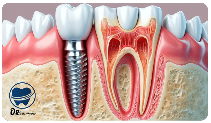 ایمپلنت فوری در مشهد