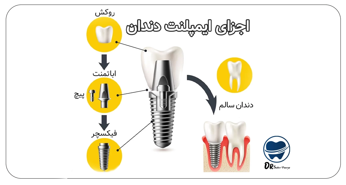 اجزای ایمپلنت دندانی