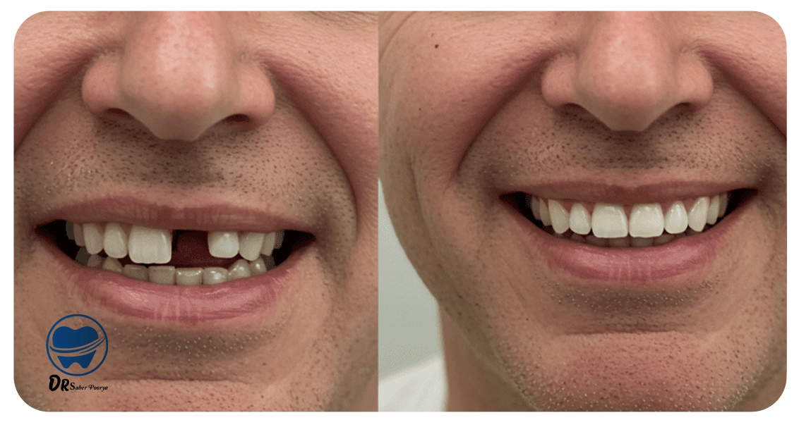 چه عواملی باعث افزایش طول عمر ایمپلنت می شوند؟