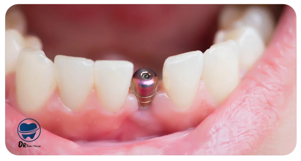 متخصص ایمپلنت در مشهد