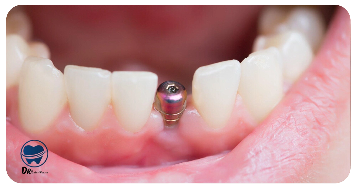 عوامل مضر و مؤثر در کاهش طول عمر ایمپلنت دندان