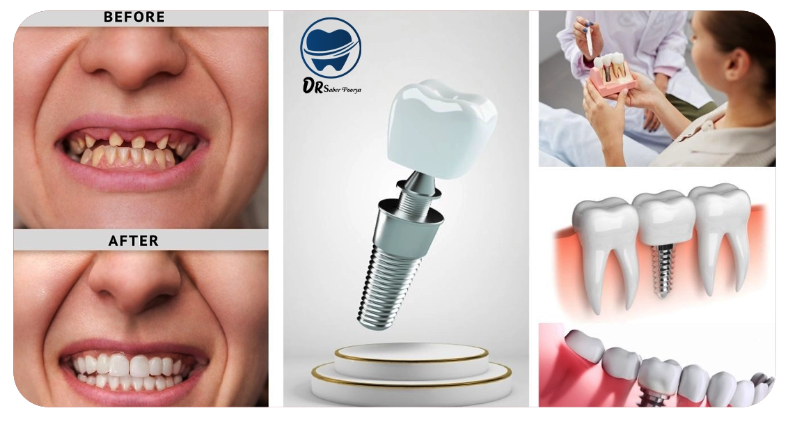 عوامل موثر بر طول عمر ایمپلنت