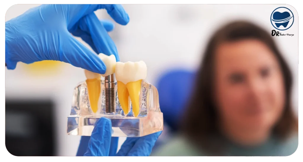 چه افرادی نمی توانند ایمپلنت دندان انجام دهند؟