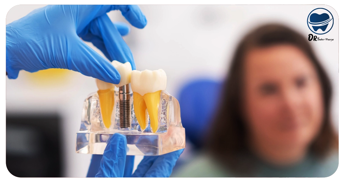 عمر ایمپلنت دندان چقدر است؟