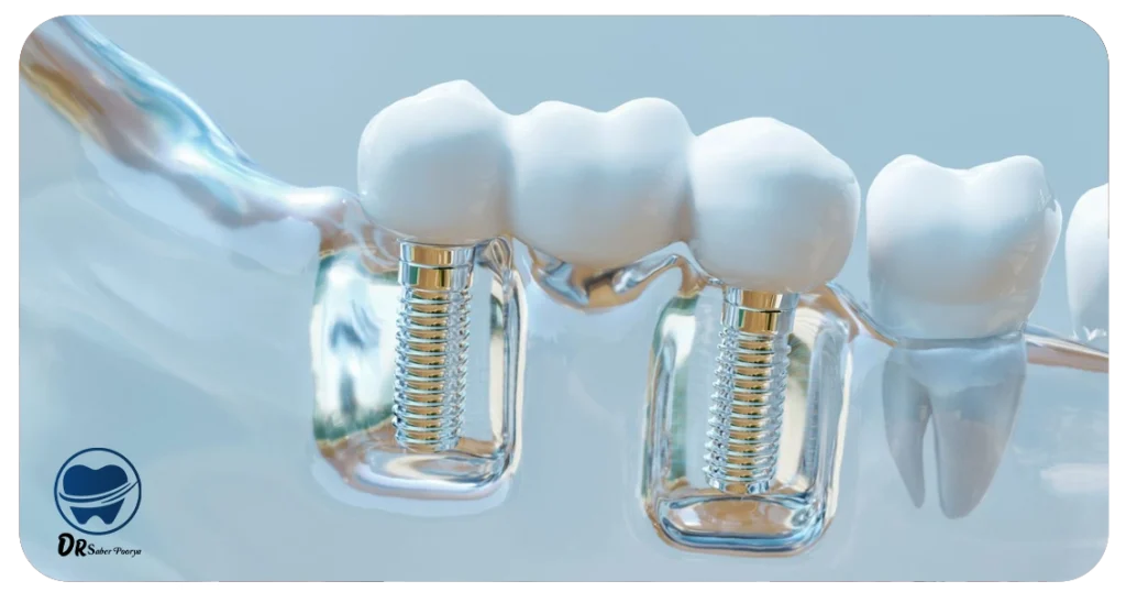 اگر پیچ ایمپلنت بیفتد چه کنیم؟