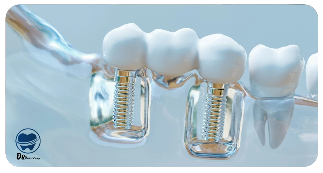 اگر پیچ ایمپلنت بیفتد چه کنیم؟