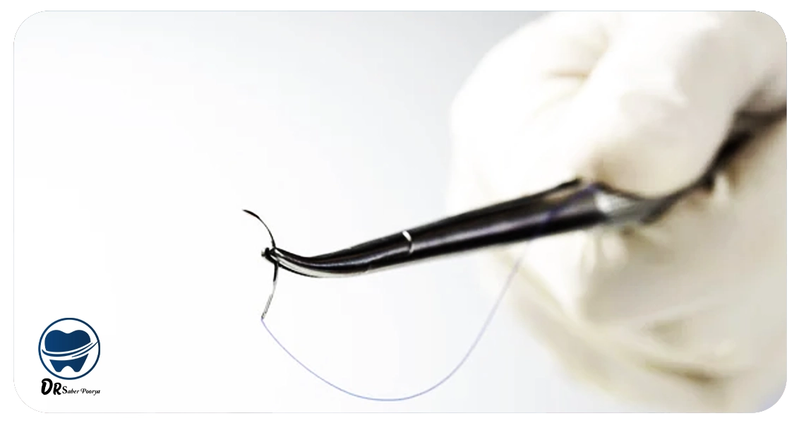 بخیه ایمپلنت دندان