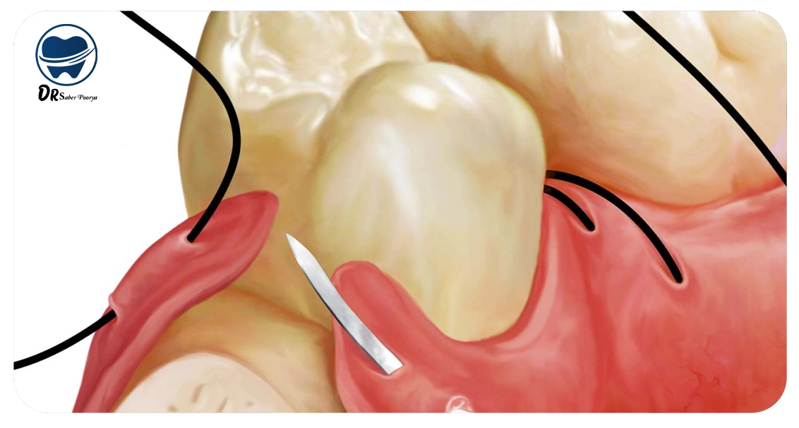 ایمپلنت دندان مشهد