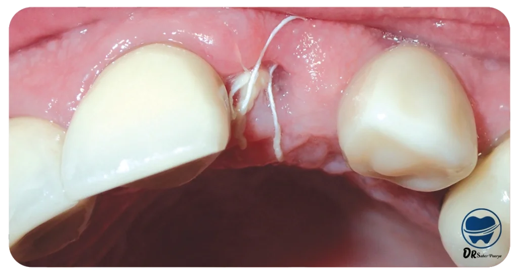 نکات مهم درباره بخیه ایمپلنت