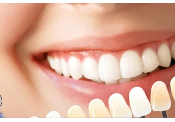 بهترین متخصص لمینت در مشهد