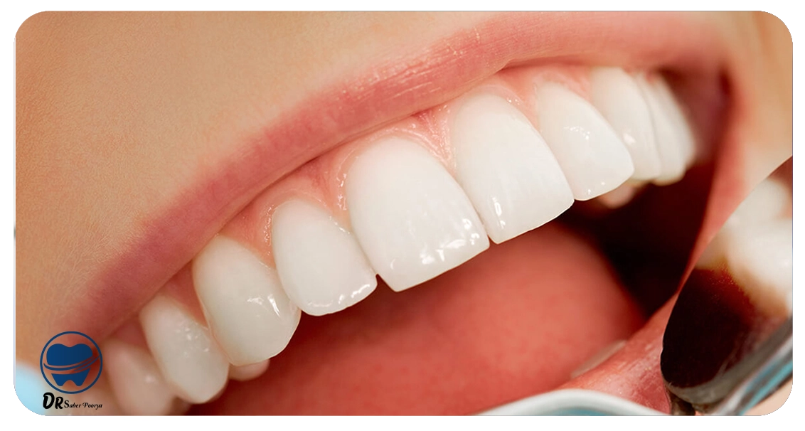 ریمو کامپوزیت دندان مشهد